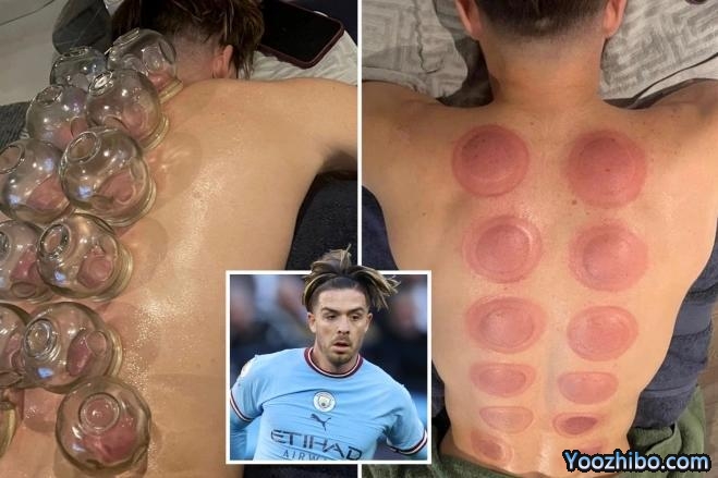 来自东方的力量，格拉利什拔火罐治疗