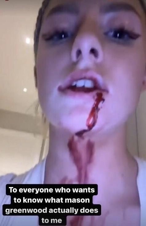 00后模特女友遭曼联20岁红星殴打！晒嘴角流血图控诉，身上多处淤青