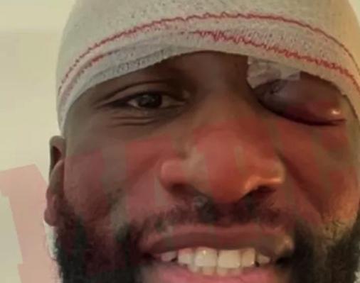 马卡曝出吕迪格伤眼照片：肿胀严重